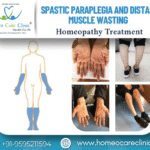 wasting and nerve degeneration in spastic paraplegia