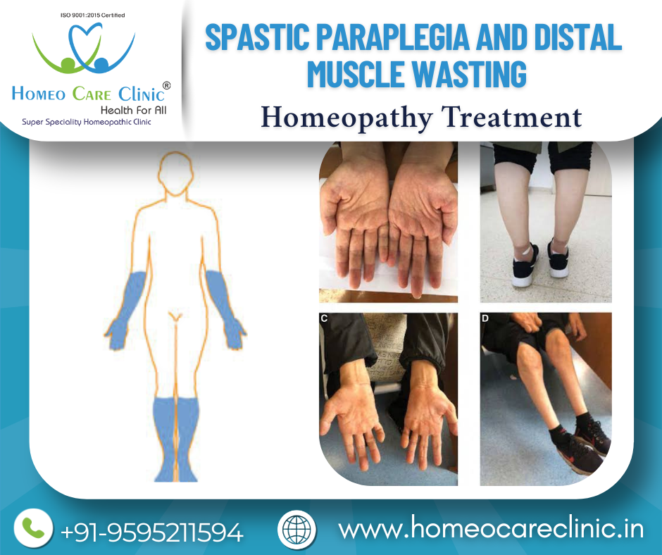 wasting and nerve degeneration in spastic paraplegia
