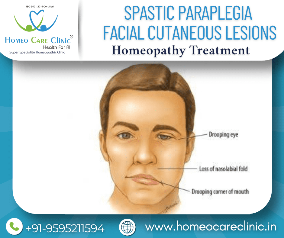 homeopathic treatment for spastic paraplegia