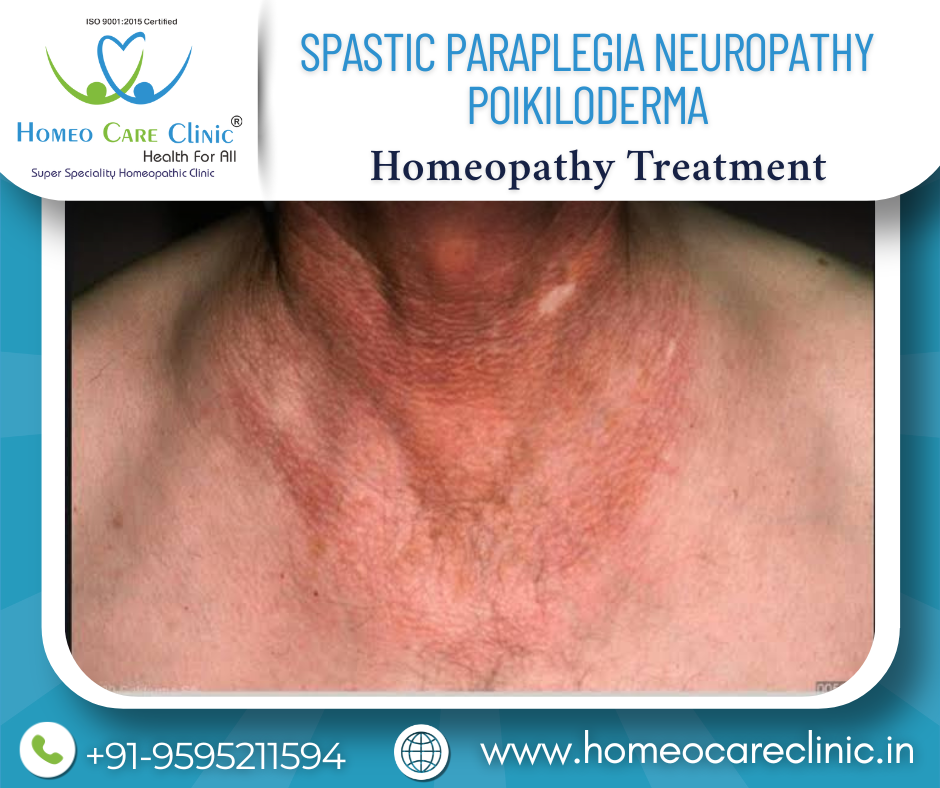 Spastic Paraplegia Neuropathy Poikiloderma