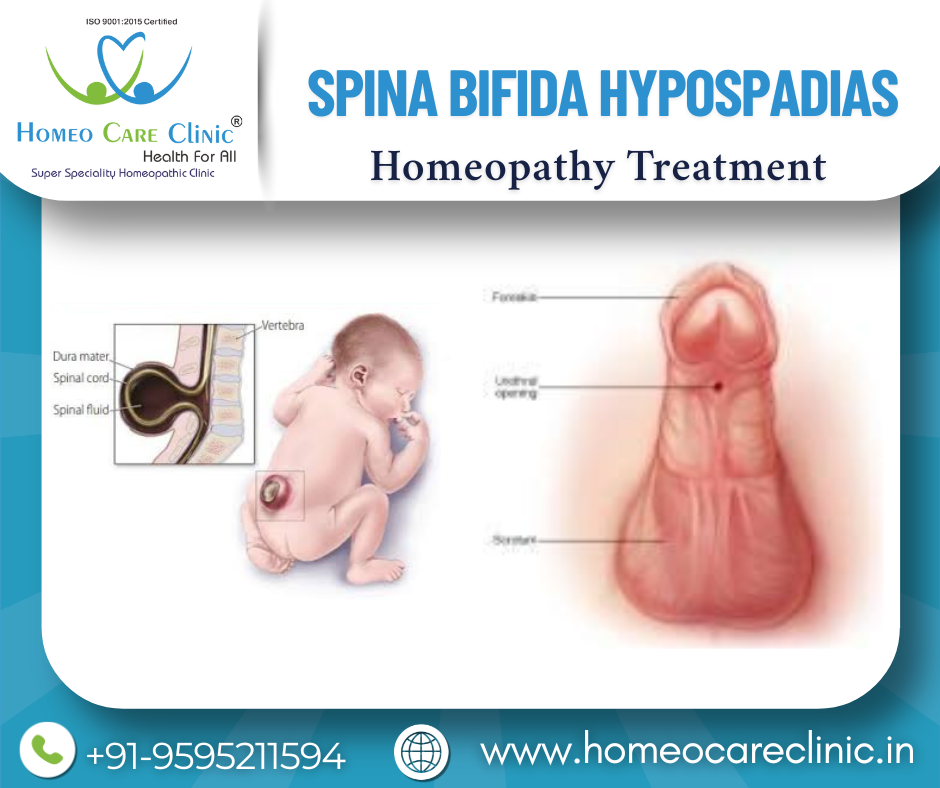 Congenital care for Spina Bifida