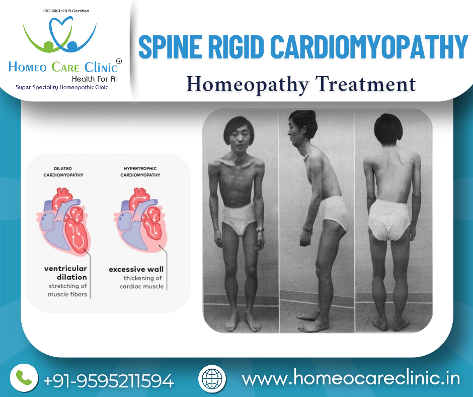 Spine Rigid Cardiomyopathy and homeopathy treatment