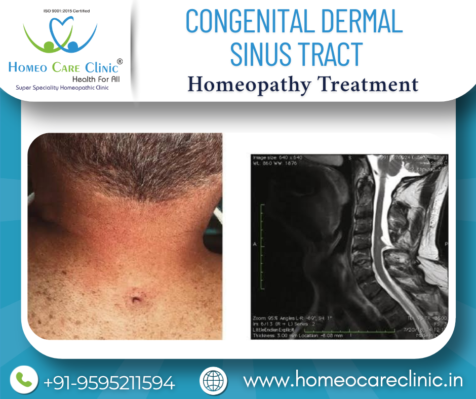 spinal dermal sinus tract