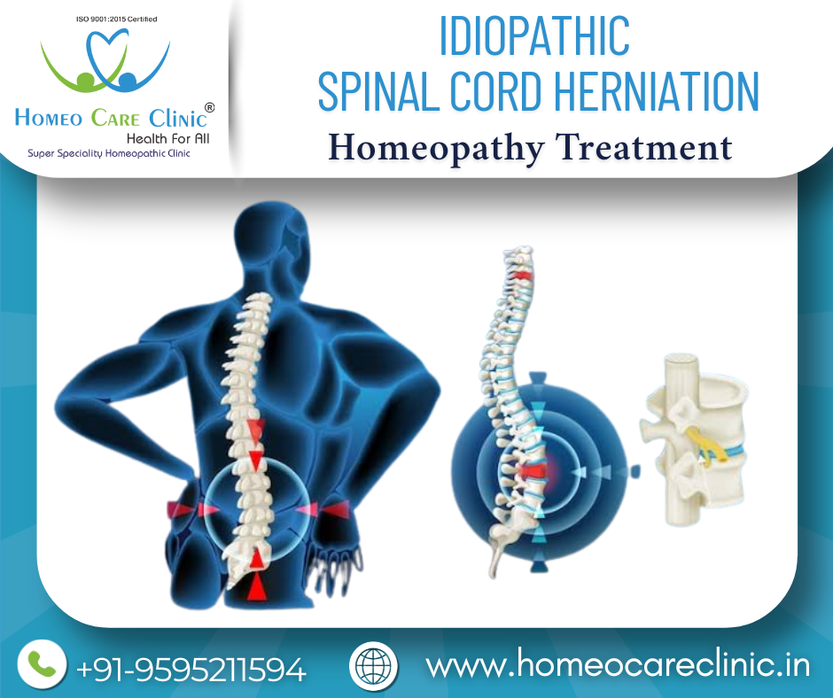 Idiopathic Spinal Cord Herniation