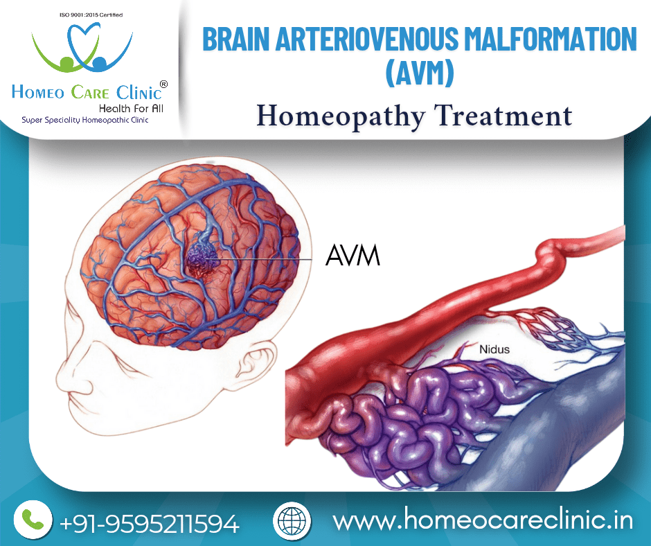 brain AVM diagnosis treatment