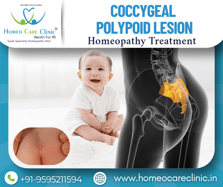 Coccygeal Polypoid Lesion near the tailbone