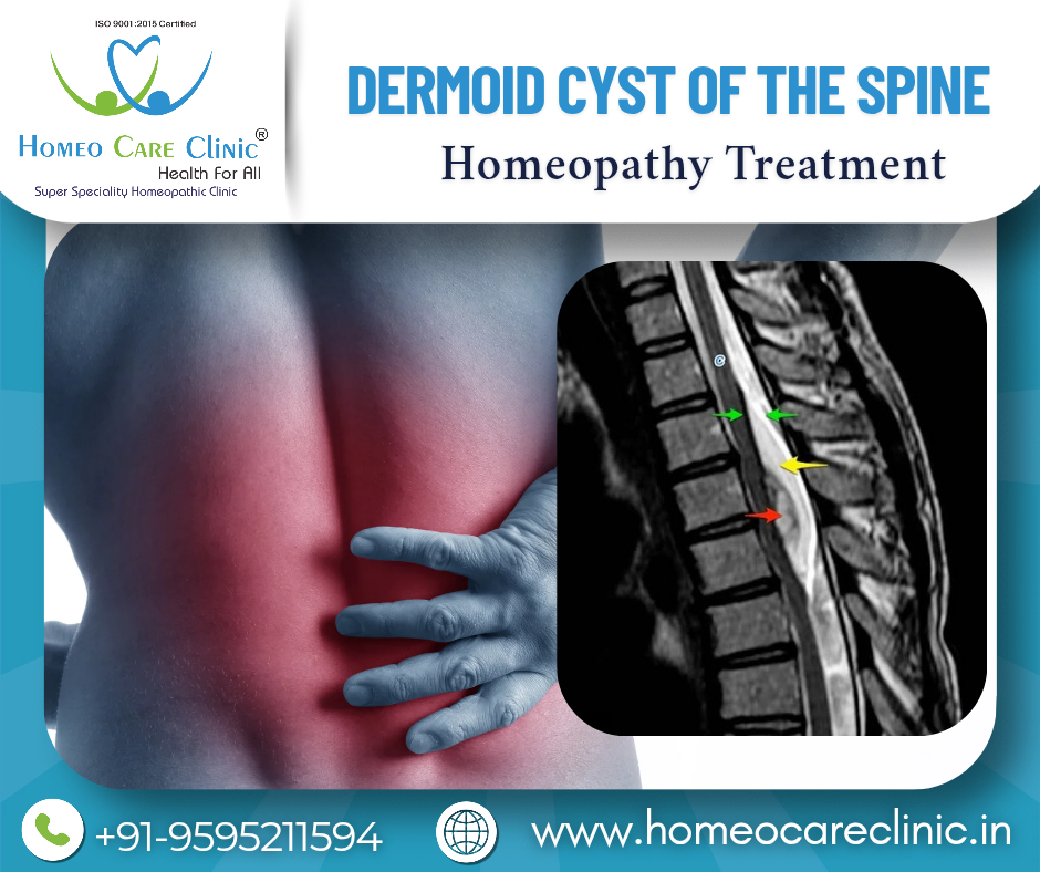 MRI image of spinal dermoid cyst in lower back