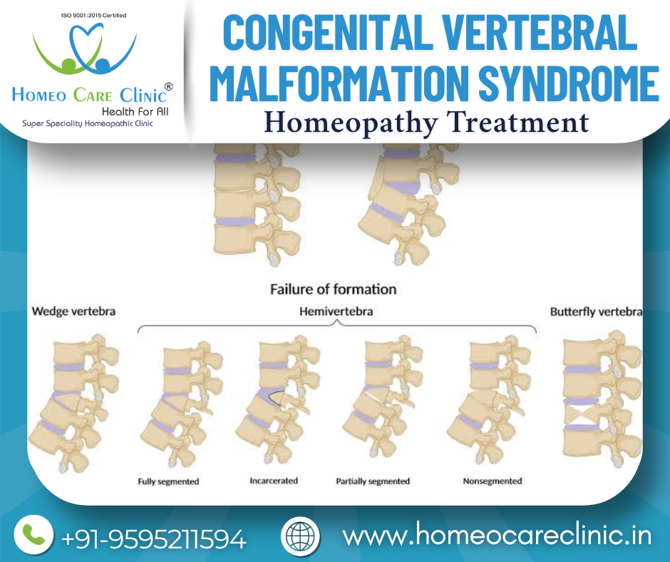 Congenital Vertebral Malformation Syndrome