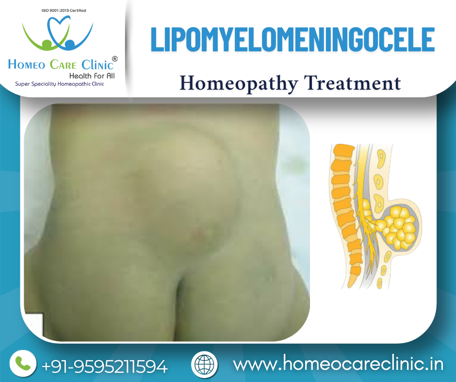 Lipomyelomeningocele