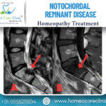 Notochordal Remnant Disease and its treatment