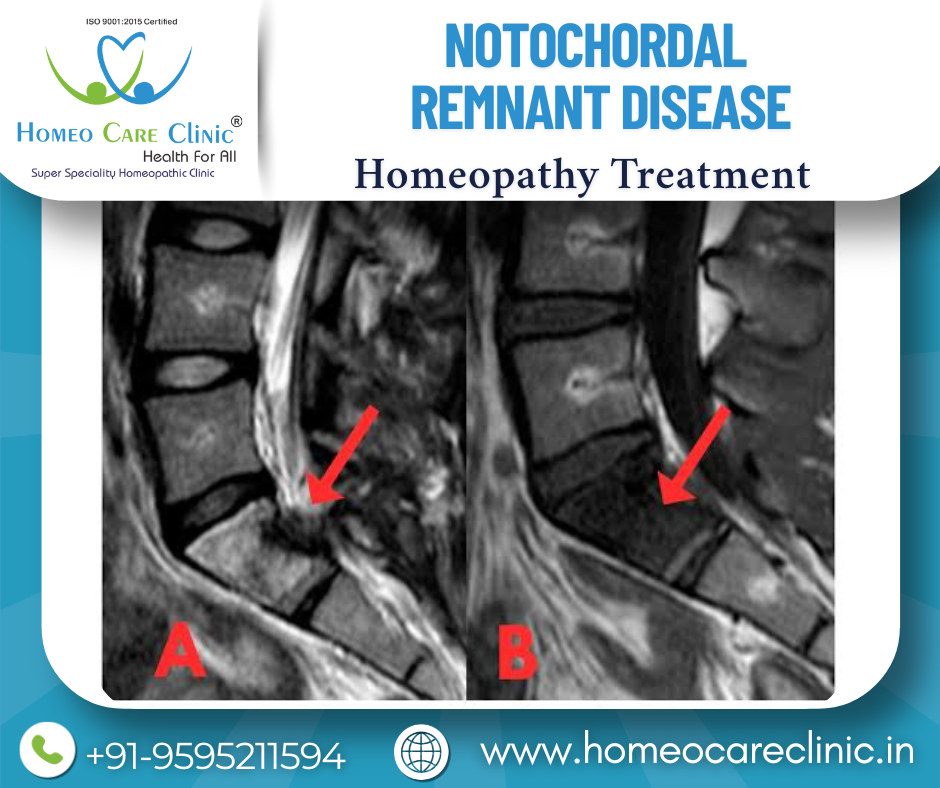Notochordal Remnant Disease and its treatment