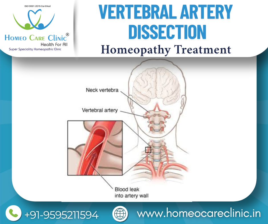 Vertebral Artery Dissection