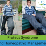Alt Text: Proteus Syndrome Medicine