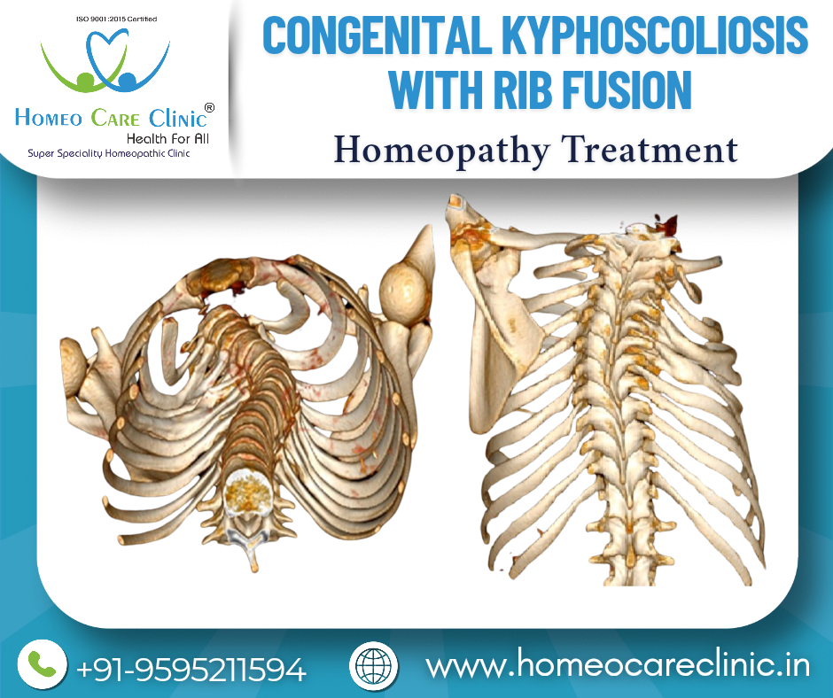 Homeopathic support for Congenital Kyphoscoliosis with Rib Fusion