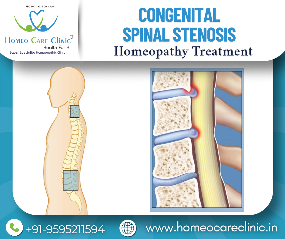 Homeopathic treatment for Congenital Spinal Stenosis