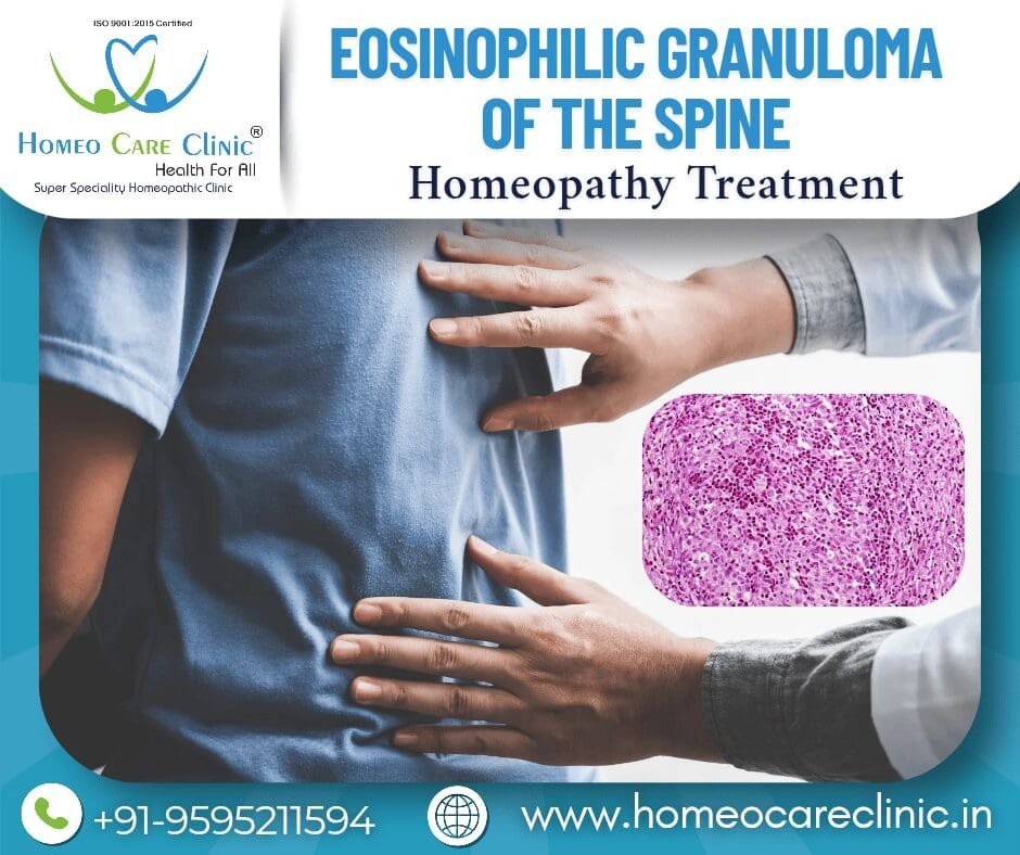 Homeopathic management for Spinal Eosinophilic Granuloma