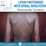 Lipoid Proteinosis with Spinal Involvement Treatment