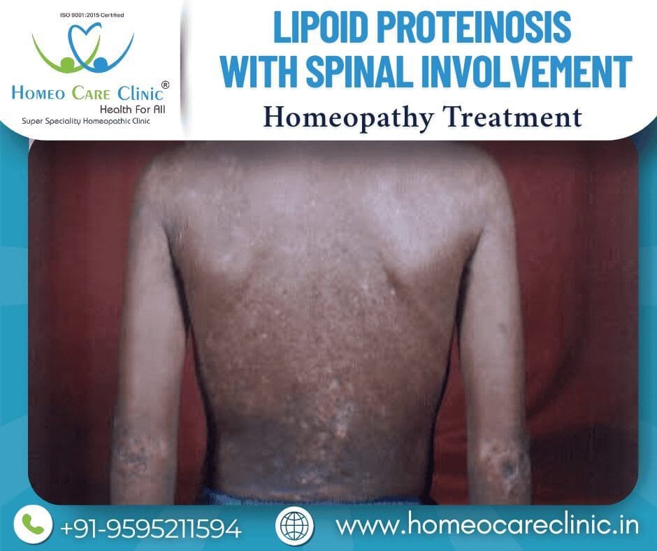 Lipoid Proteinosis with Spinal Involvement Treatment