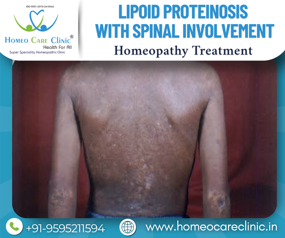 Lipoid Proteinosis with Spinal Involvement Treatment