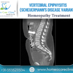 Natural remedies for Vertebral Epiphysitis