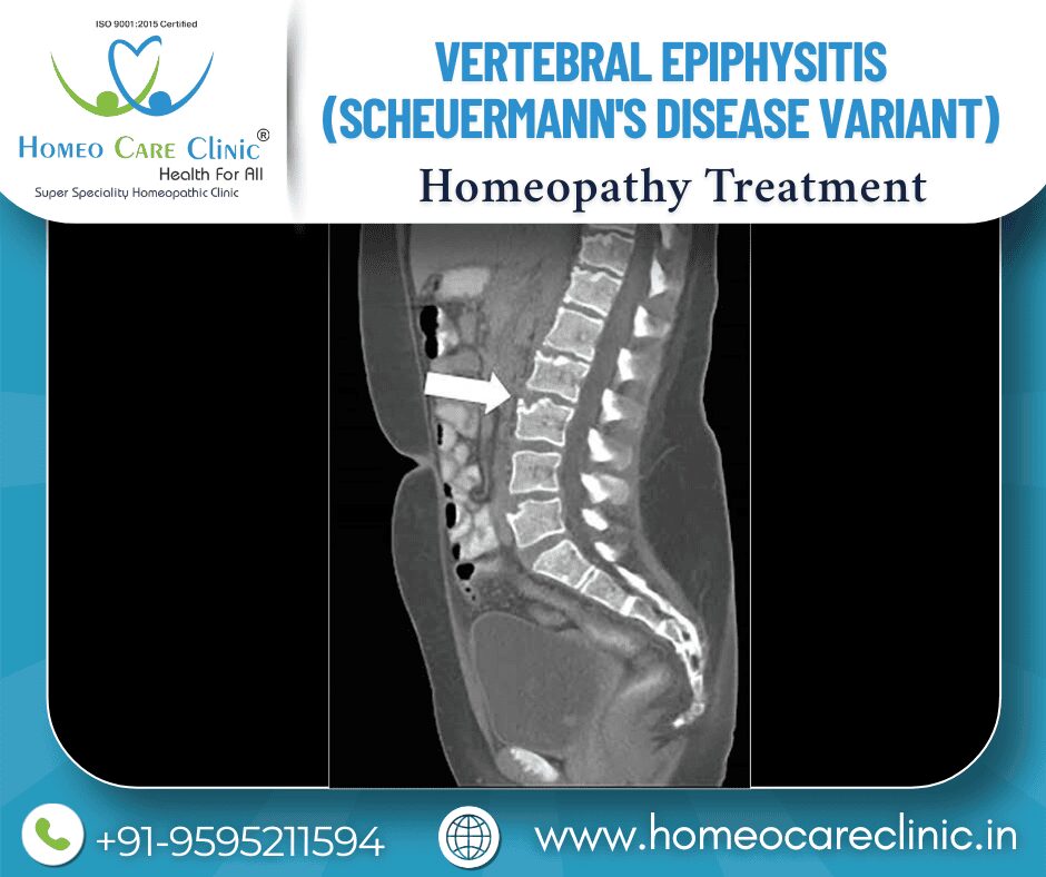Natural remedies for Vertebral Epiphysitis