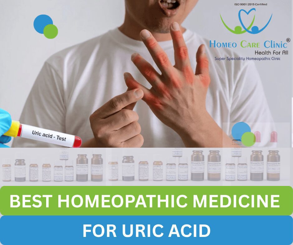 Best Homoeopathic Medicine for Uric Acid