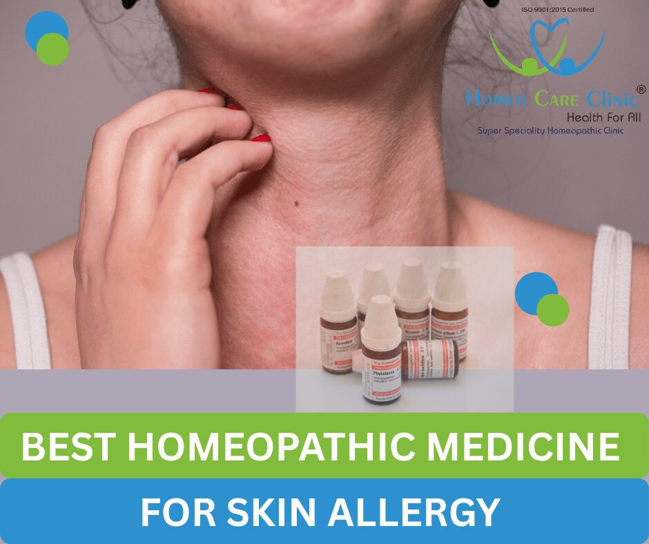 Best homeopathy remedies for skin allergy and eczema