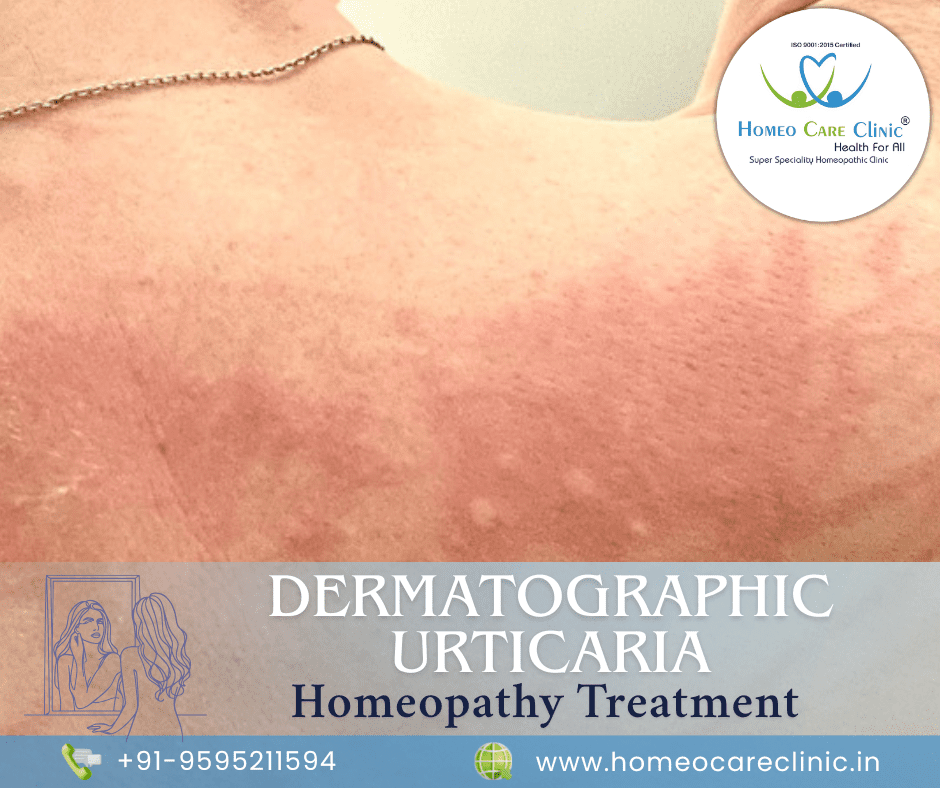 Dermatographic Urticaria