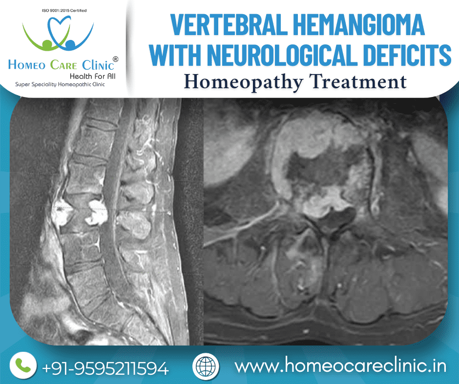 Spinal nerve pain and vertebral hemangioma management
