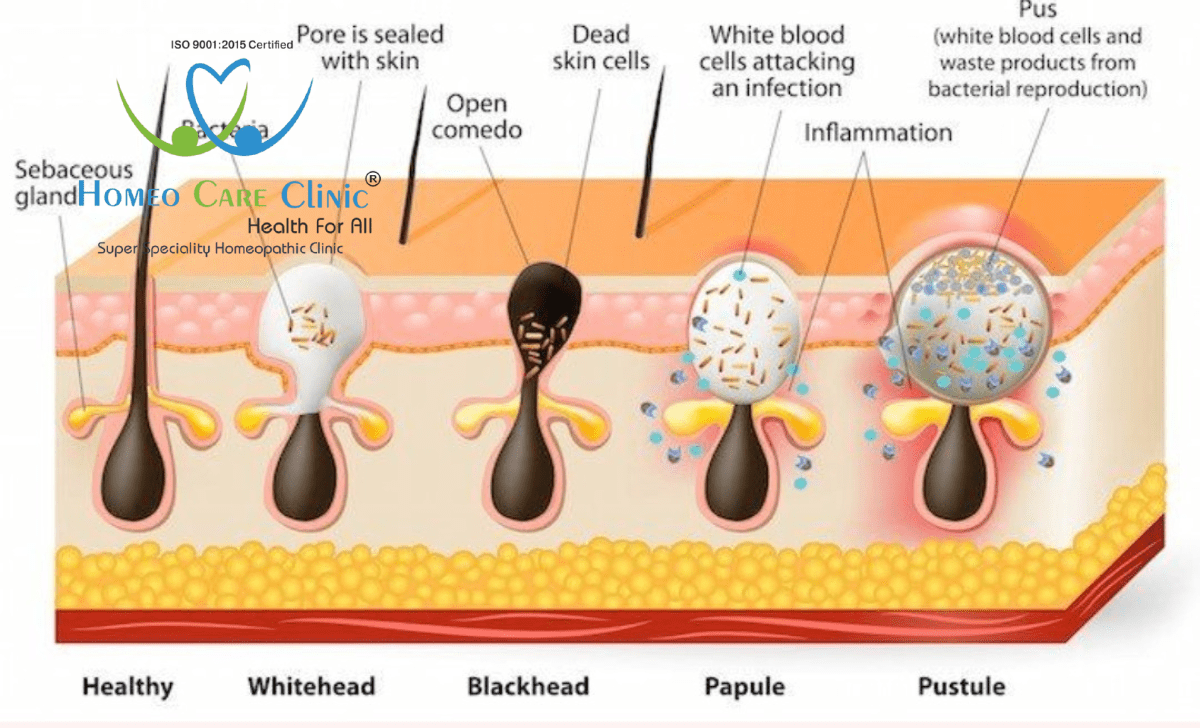 Acne types and treatment