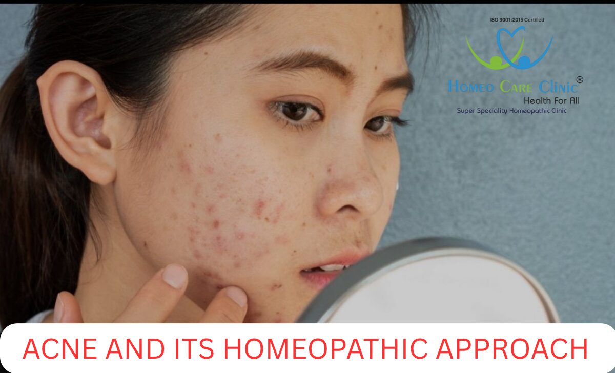 Acne types and treatment