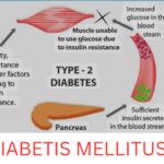 Diabetes Mellitus