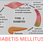 Diabetes Mellitus