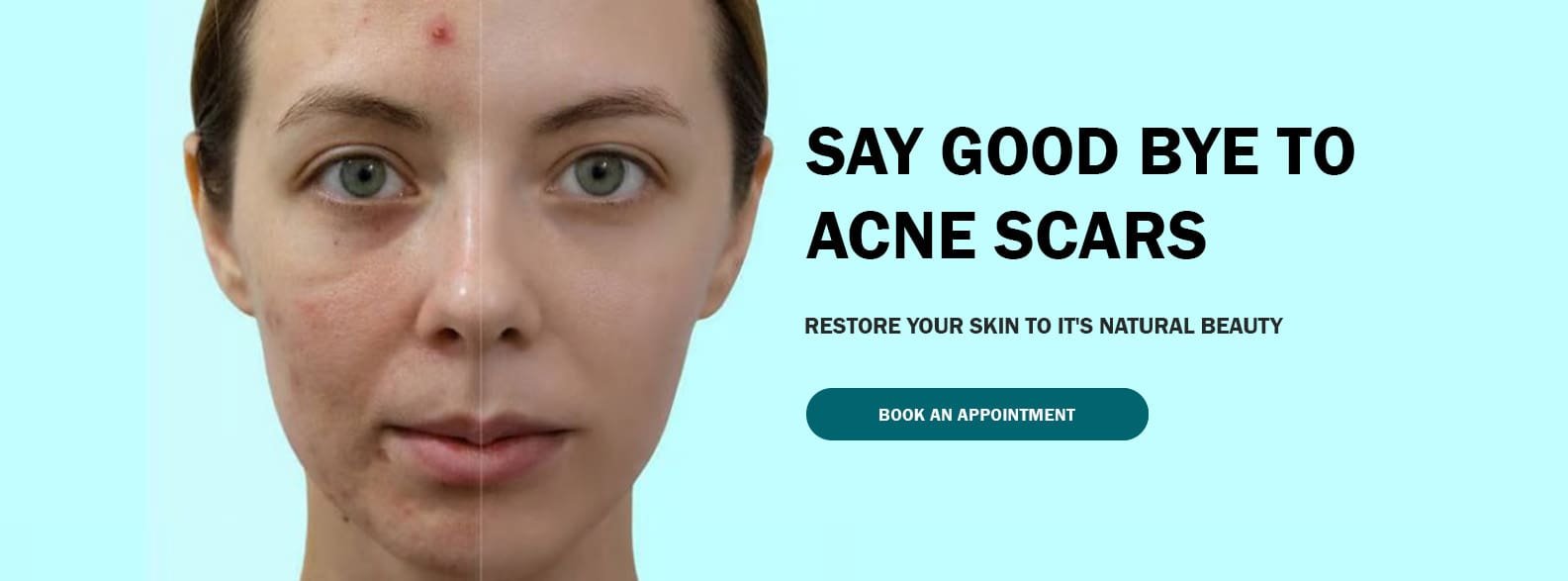 SAY GOOD BYE TO ACNE SCARS