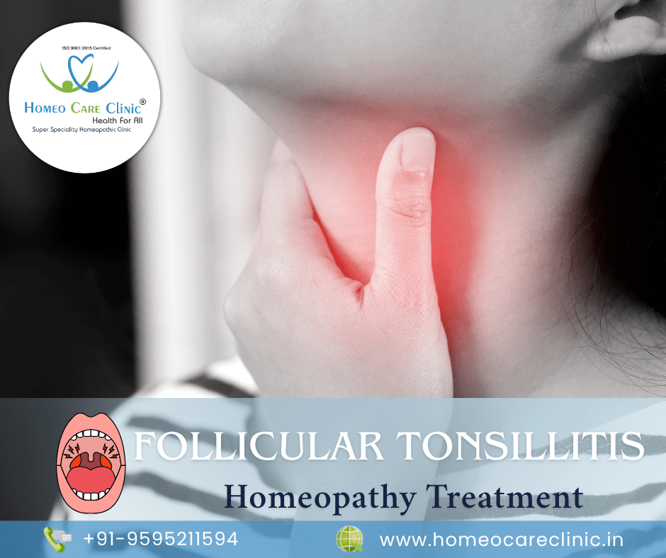 follicular tonsillitis treatment