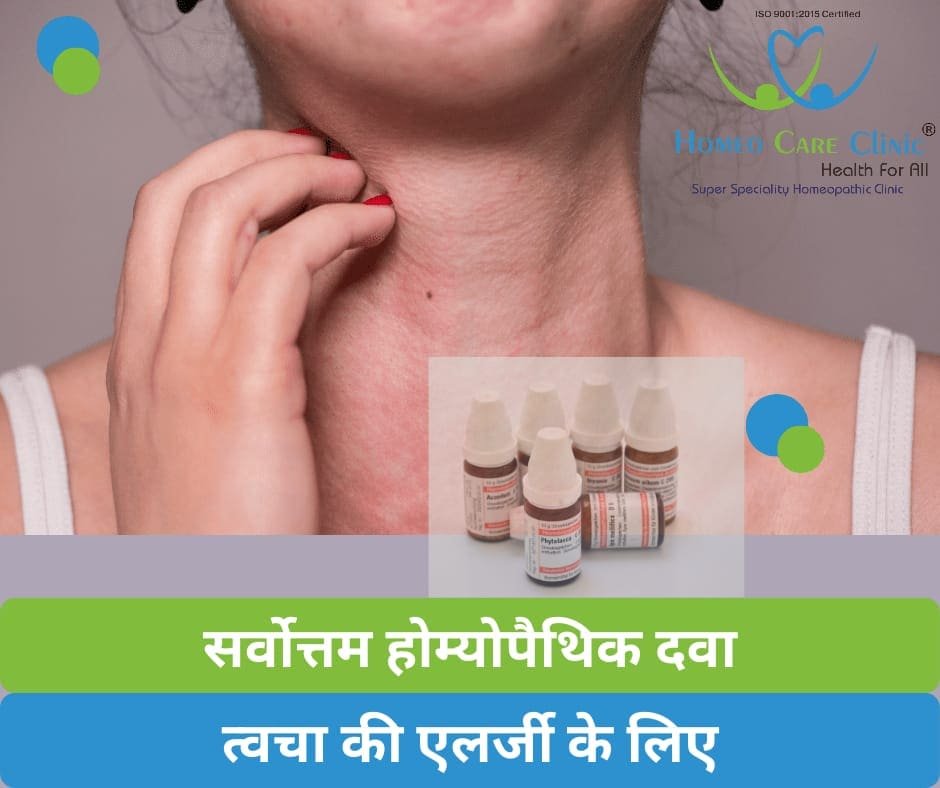 Twacha ki allergy