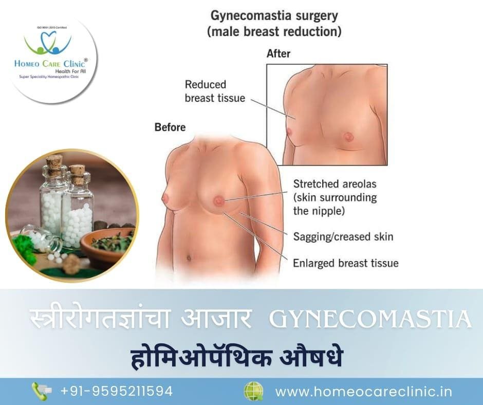 Medicine for Gynecomastia in Marathi