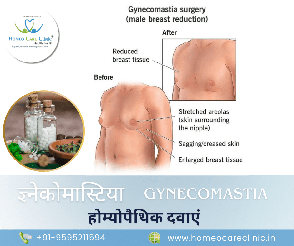 Medicine for Gynecomastia in Hindi