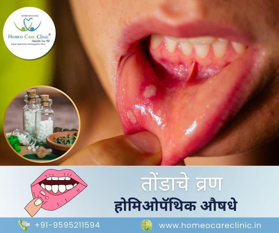 ulcers and homeopathy medicines in marathi