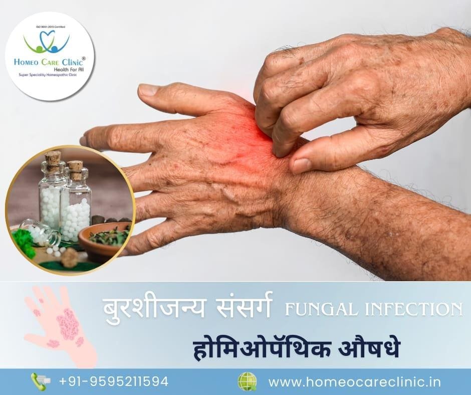 Medicines for Fungal Infection on Skin in marathi