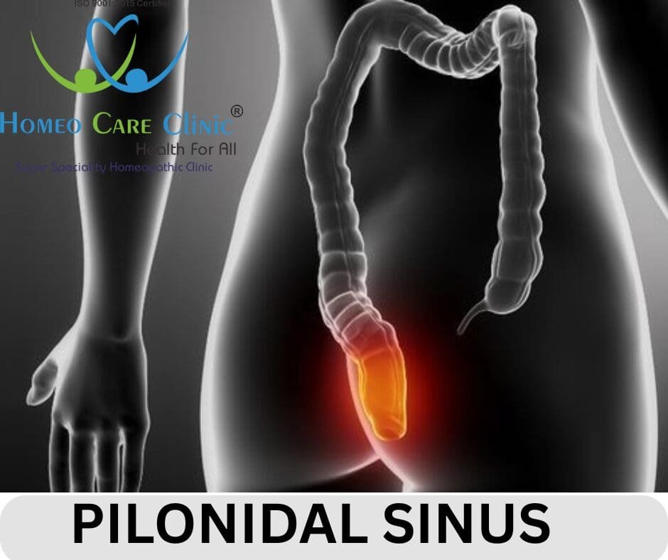 Pilonidal Sinus Symptoms & Causes