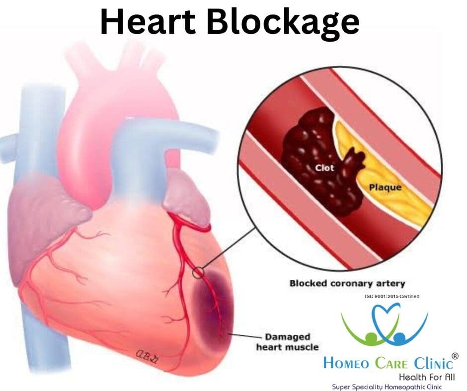 Heart Blockage Reasons and Types