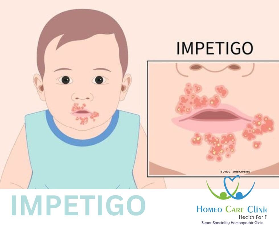 Impetigo: Causes, Symptoms & Treatment