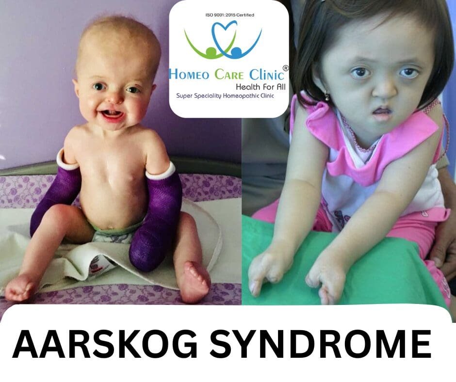 Aarskog Syndrome: Causes, Symptoms, Homeopathic Approach